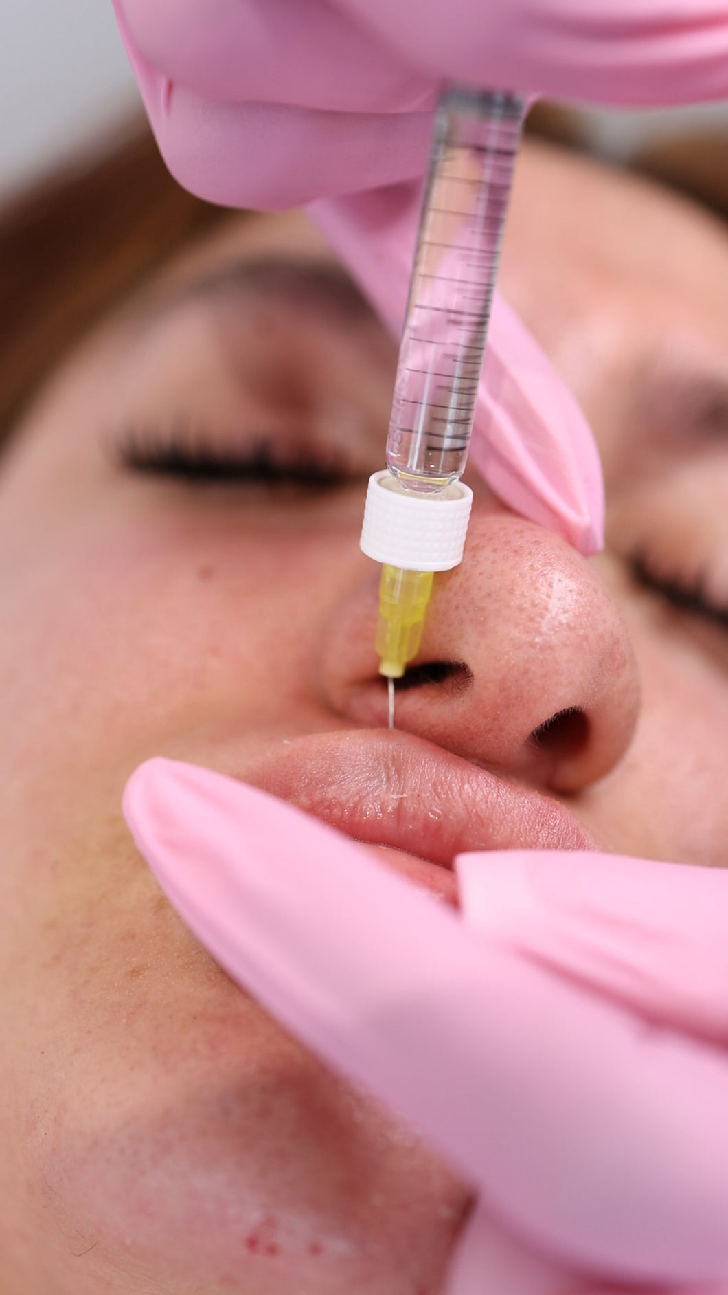 Lip filler 1ML - Signature Technique