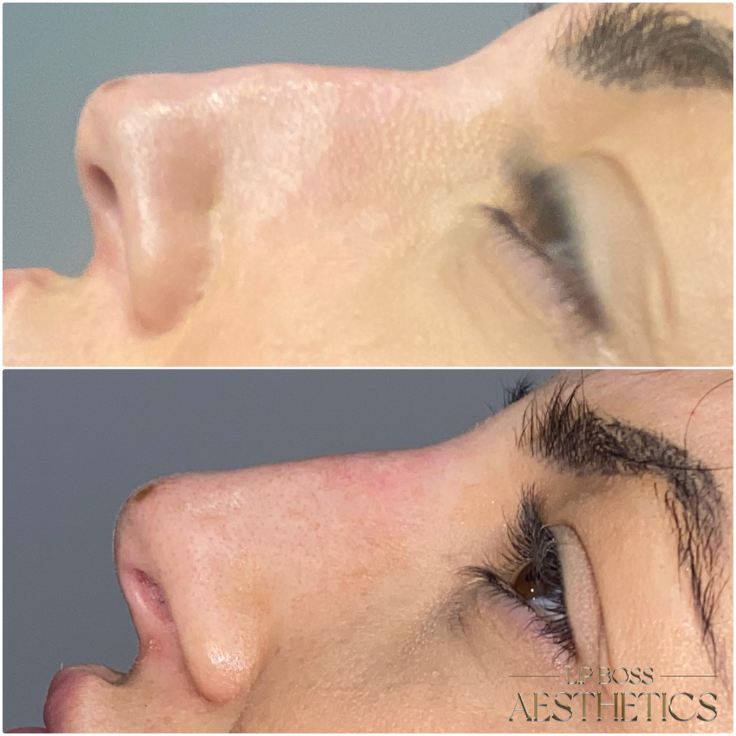 360 Liquid Rhinoplasty