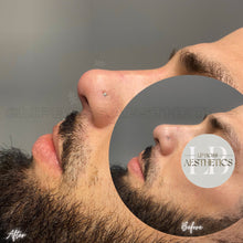 Load image into Gallery viewer, 360 Liquid Rhinoplasty
